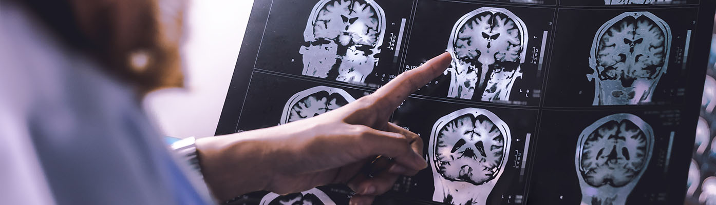 brain atrophy on MRI of Dementia patient
