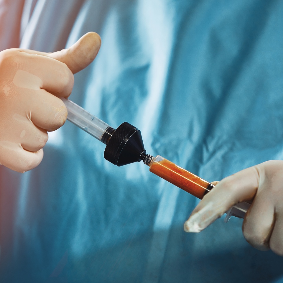 A set of operating tools for cleaning adipose tissue. separation of fat before transplantation. Plastic surgery, body fat, lipofilling, liposuction.