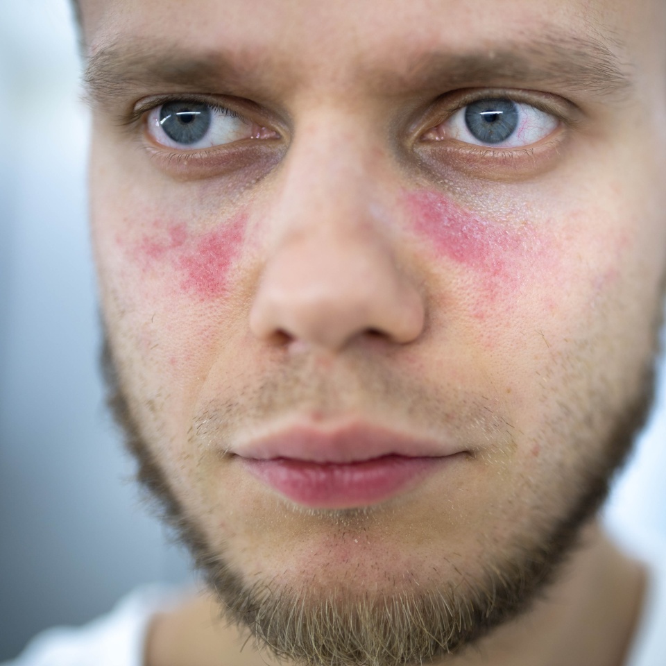 age spots of redness on the face, a young man is sick systemic lupus erythematosus