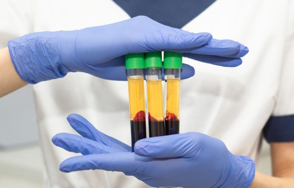 Close up Medic woman hand in blue medical gloves holds 3 test tubes with blood plasma. Concert of laboratory blood tests and cosmetic injections for the beauty of skin and hair.