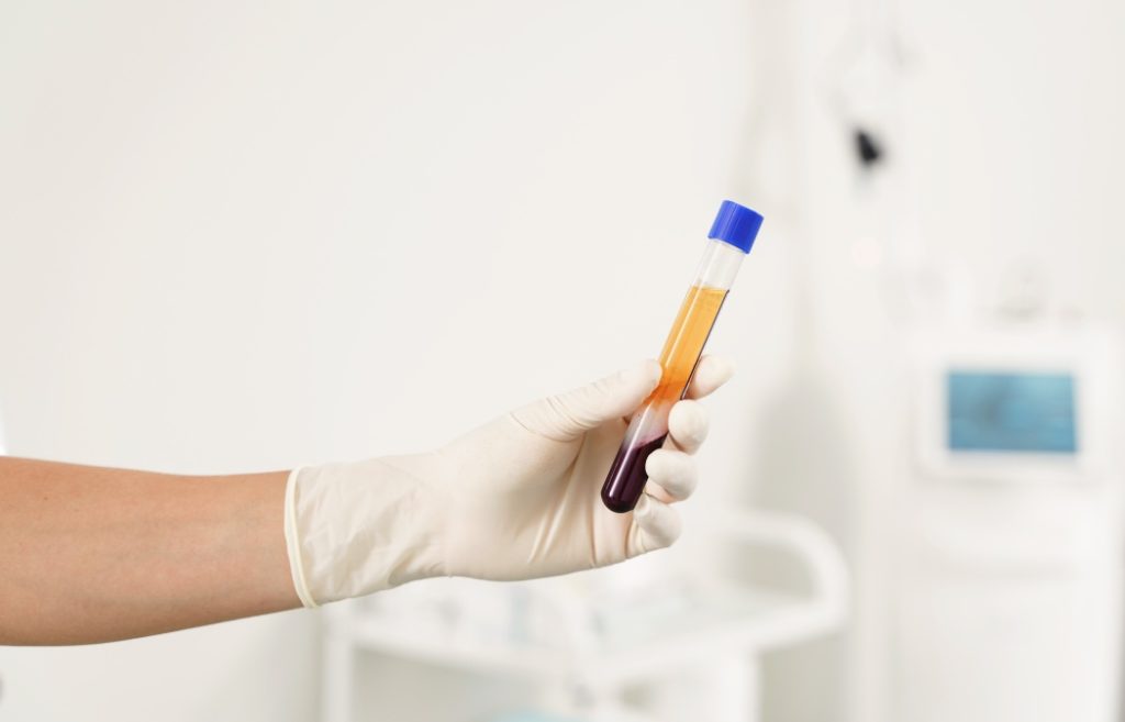 Nurse holding vacutainer with a platelet-rich plasma and blood for PRP treatment