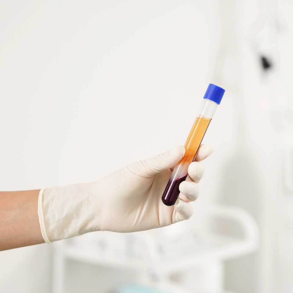 Nurse holding vacutainer with a platelet-rich plasma and blood for PRP treatment