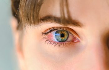 Tired eyes and contact lenses. Close up. Green eyes of a teenager inflamed and with red veins