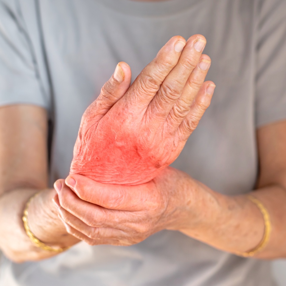 Hand joints inflammation. Concept and idea of rheumatic arthritis, rheumatism, gout, joint swelling or arthralgia.