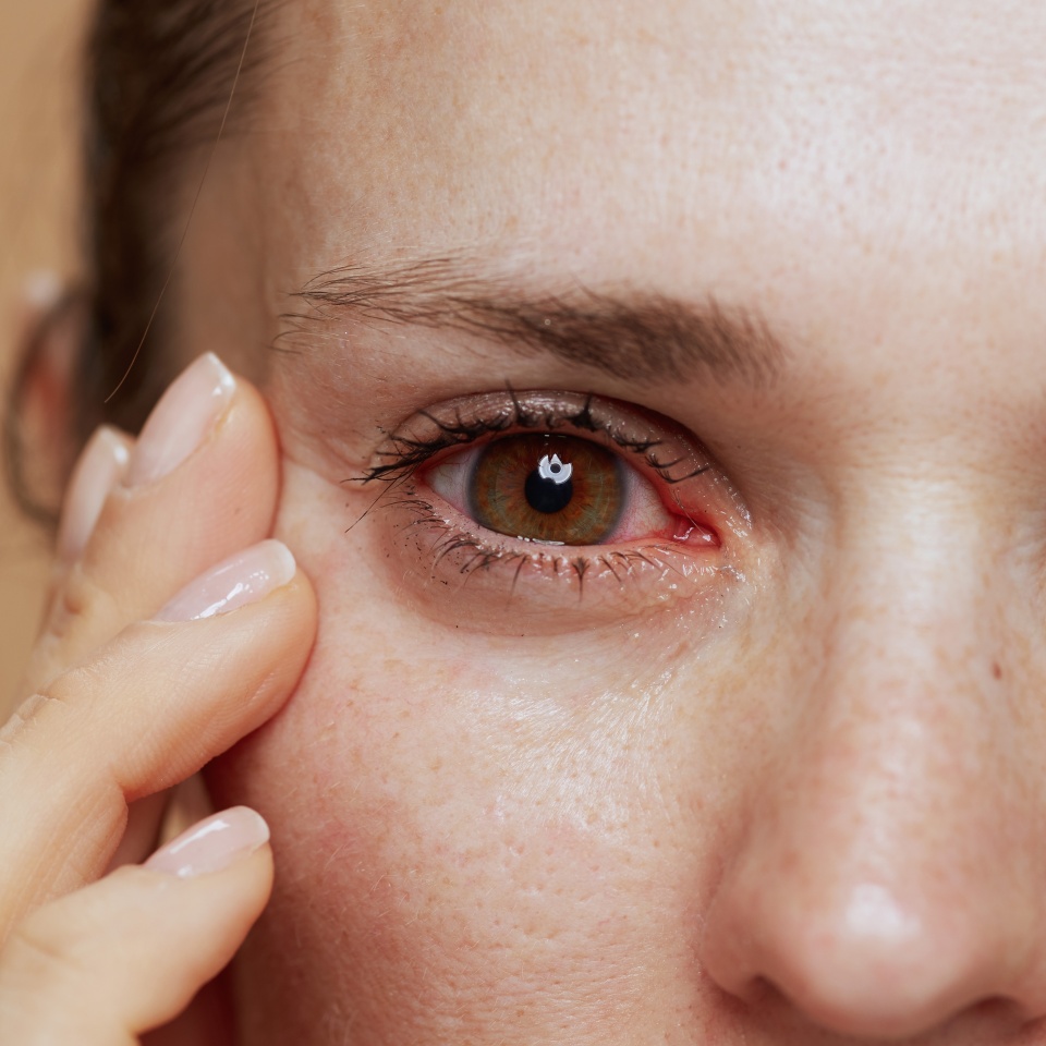 Closeup on young woman with inflamed eyes.
