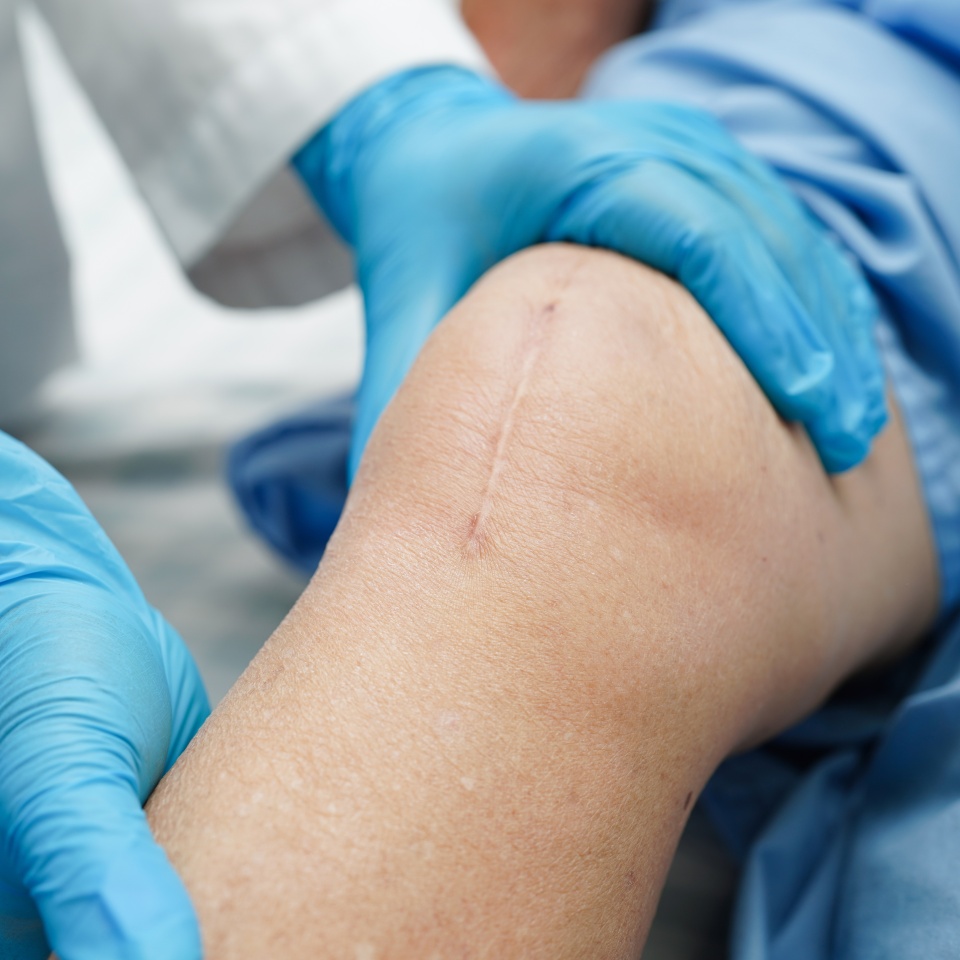 Asian elderly woman patient with scar knee replacement surgery in hospital.