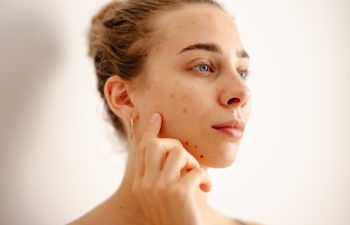 A woman touches her face gently while inspecting her skin for acne and imperfections. Pimples. Acne disease. Medicine and cosmetology.