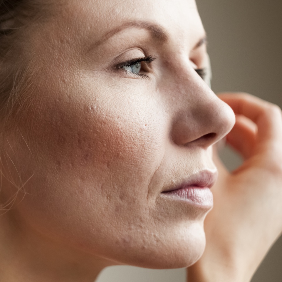 Macro shot of young woman's cheek with typical problem with acne, acne rosacea, and pimples in the adulthood time.