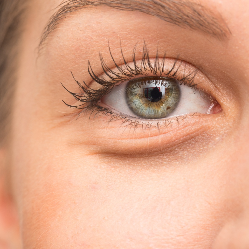 Eye bags on woman face