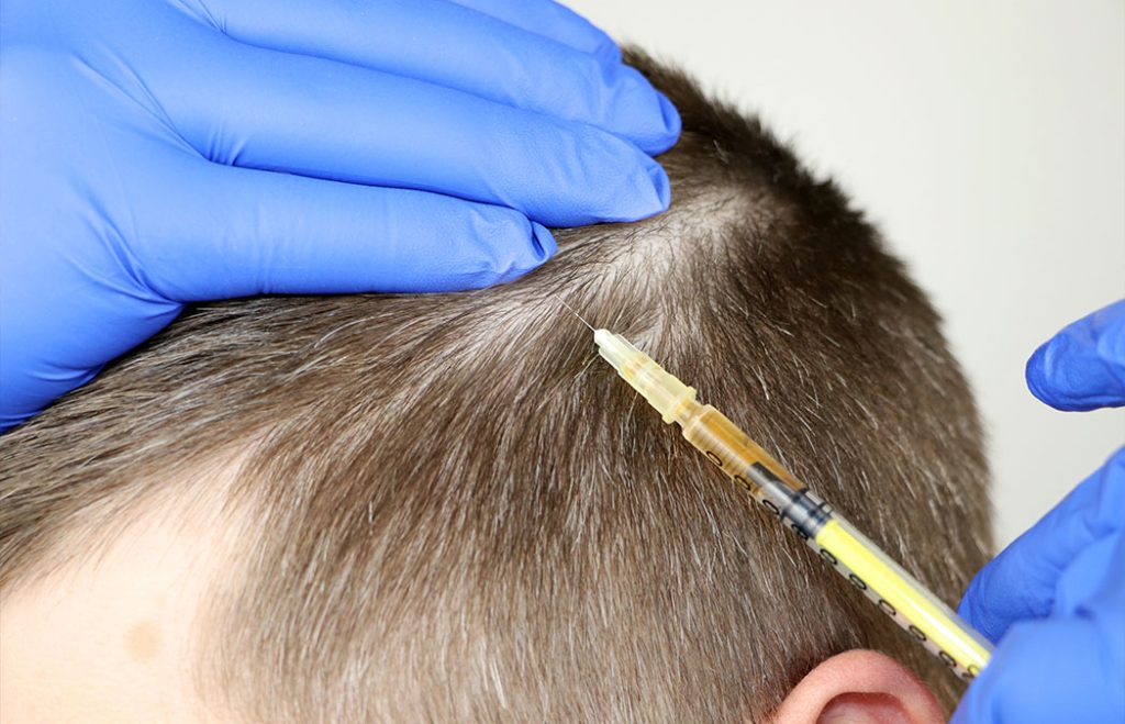 A person receives an injection in the scalp from a gloved hand, likely as a treatment for hair loss.