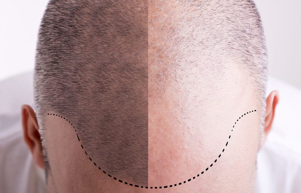 Top view of a man's scalp showing a comparison of hair density, with the left side having more hair and the right side showing thinning, separated by a dotted line.