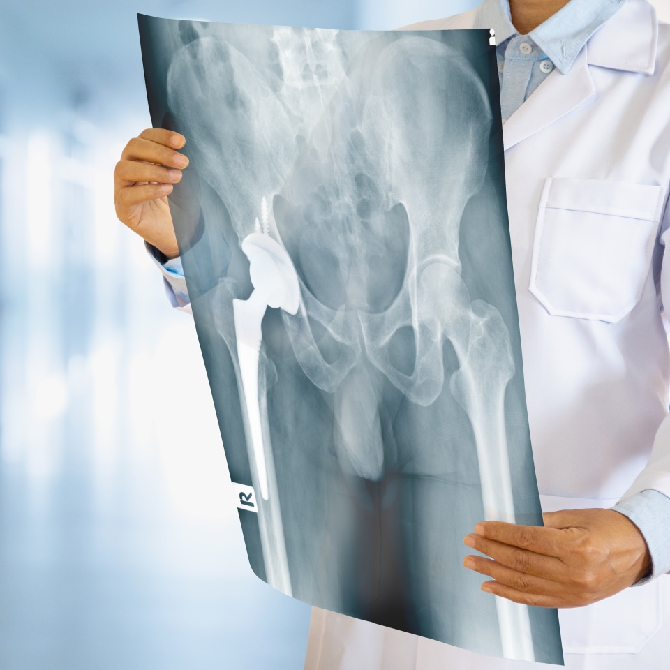 Doctor looking at total hip replacement X-ray film with blurred hospital background.