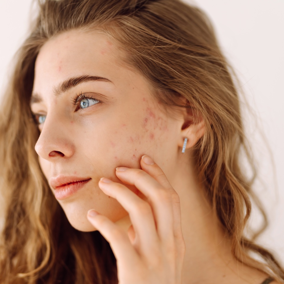 Portrait of a young girl with problem skin. Pimples, acne, pores, scars. Natural skin. Problem skin skincare.